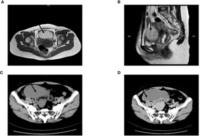Repeated misdiagnosis of small intestine bronchogenic cyst: a case report